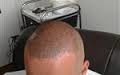 Micropigmntacion   para  alopecia   Y  densid - Imagen 1